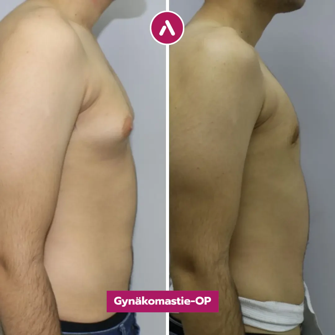 Männerbrust-OP vorher nachher, Profil rechts: kegelförmig vorstehende Brust (links), eine Woche danach gerade Brustlinie (rechts)