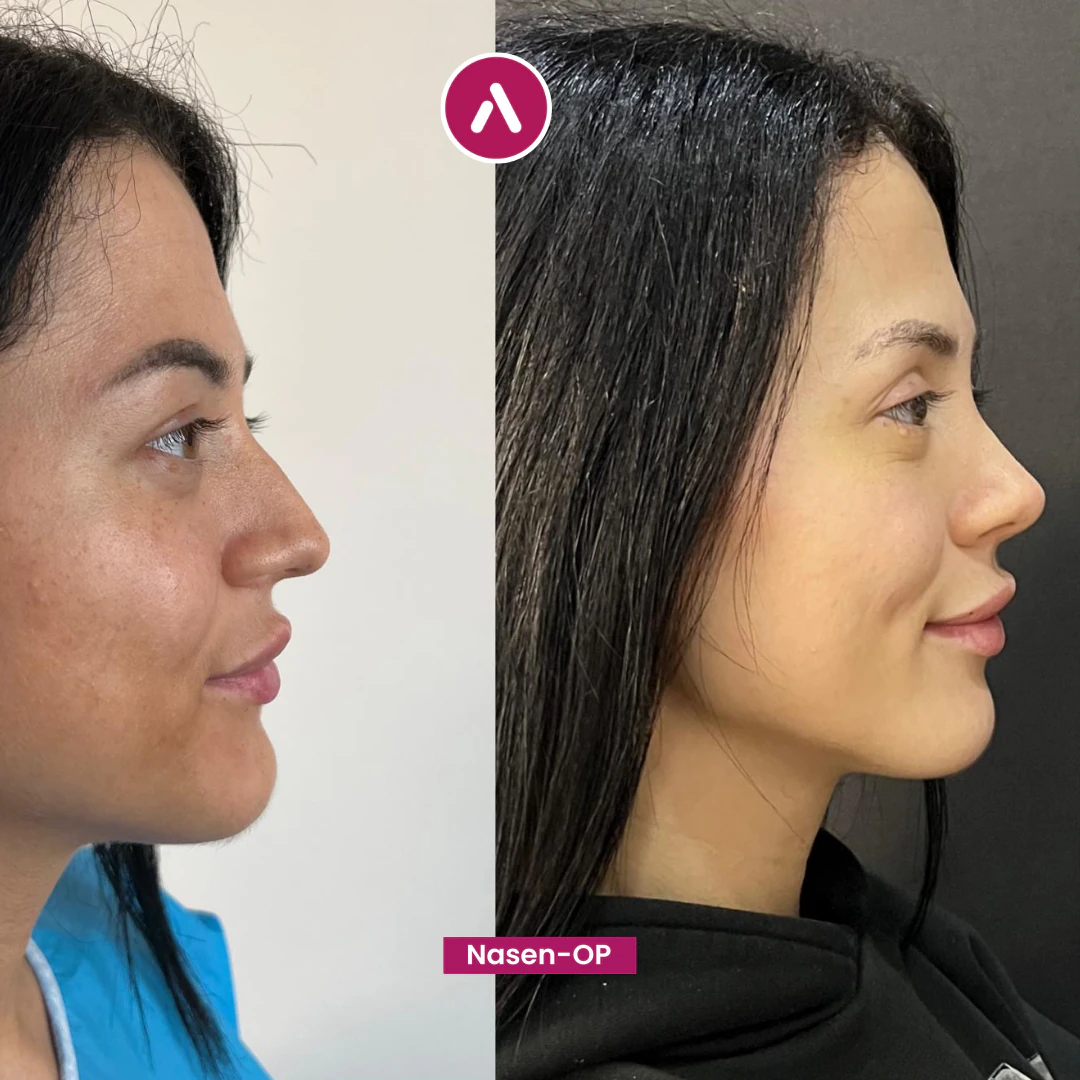 Profil rechts vorher nachher: Höcker dominiert das Profil (links), nach der Nasenkorrektur glatter, gerader Rücken (rechts)