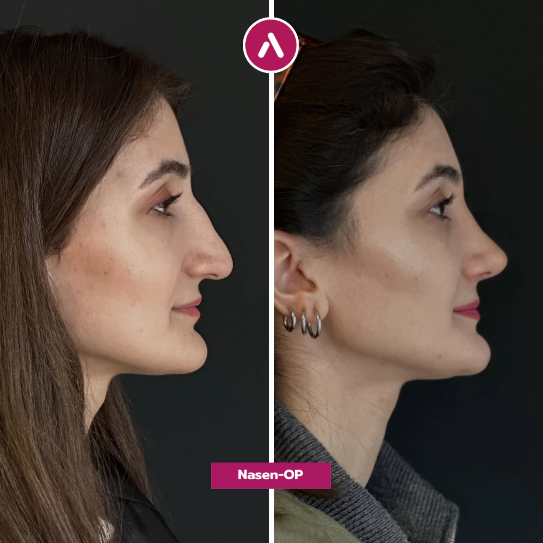 Profil rechts vorher nachher: Hakennase mit deutlichem Höcker (links), nach der OP gerader Rücken, angehobene Spitze (rechts)