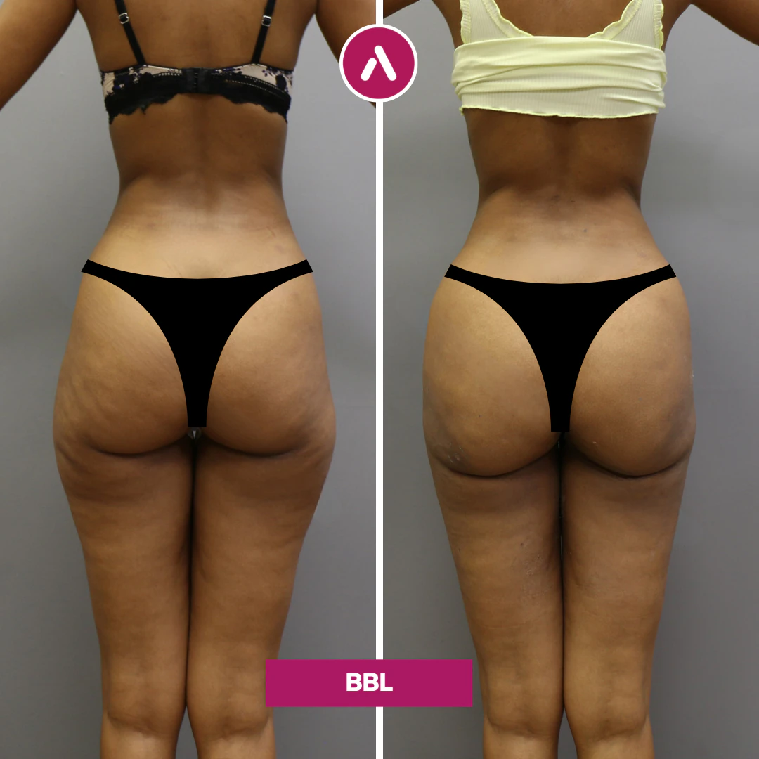 Skinny BBL vorher nachher, Rückansicht: schlanker Rumpf mit geraden Hüften (links), schmalere Taille, vollere Hüften (rechts)
