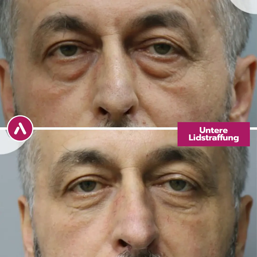 Frontal vorher nachher: ausgeprägte Tränensäcke mit dunklen Schatten (oben), nach der Unterlidstraffung glatte Unterlider (unten)