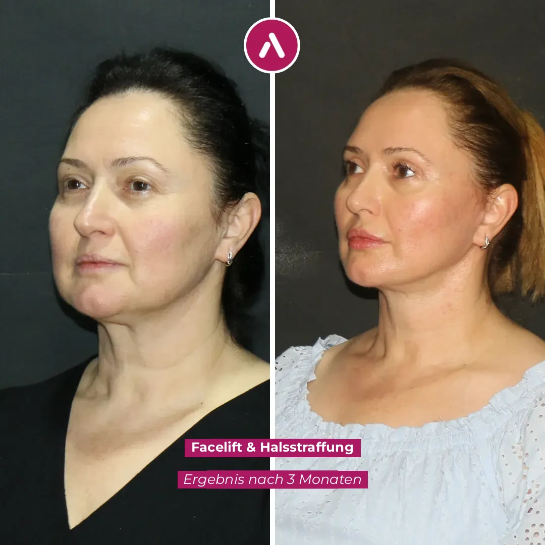 Vorher-Nachher: Facelift mit Halsstraffung bei der AKM Clinic, Ergebnis nach 3 Monaten